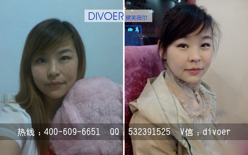 如何祛除產(chǎn)后黃褐斑 醋泡蛋祛斑的正確用法（圖）_2