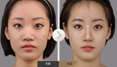 商丘做鼻翼縮小術會有疤痕嗎?（圖）_1