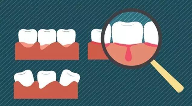 引起牙齦出血的原因有哪些？漱小白牙齦統(tǒng)計據(jù)說有80%的人不懂牙齦護理（圖）_4