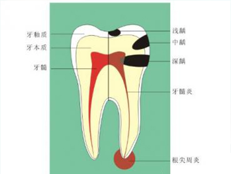 龋齿是如何形成的？漱小白教您如何预防蛀牙 （图）_2
