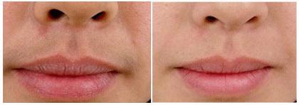 商丘華美激光脫唇毛要幾次脫干凈？（圖）_1