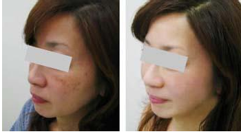 商丘美白針效果維持的時間？（圖）_1