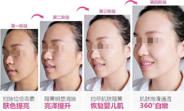 商丘美白針效果維持的時間？（圖）_2