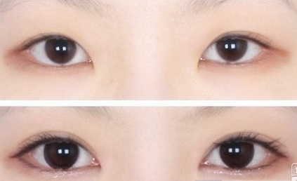 商丘華美整形朱紀國醫(yī)生修復雙眼皮案例（圖）_1