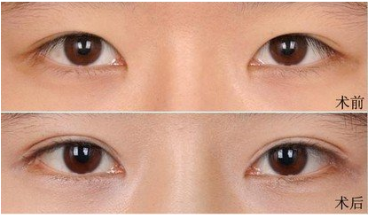 商丘華美整形朱紀國醫(yī)生修復雙眼皮案例（圖）_2