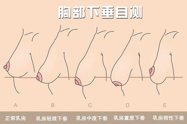 胸部下垂怎么调整?乳房下垂的原因是什么?（图）_1