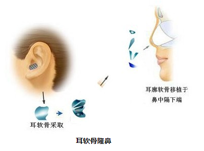 商丘耳软骨隆鼻哪家医院做的好？（图）_1