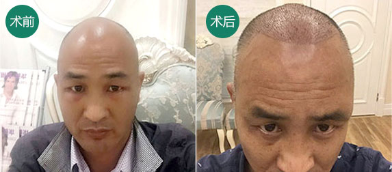 商丘頭發(fā)種植價(jià)格（圖）_1