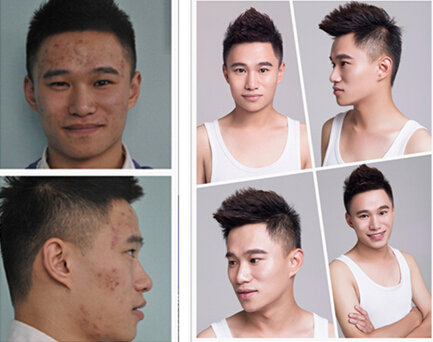 商丘激光去痘，祛痘套餐，果酸祛痘效果！（圖）_2