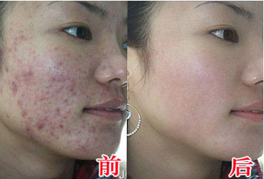 商丘激光去痘坑效果怎么樣？（圖）_1