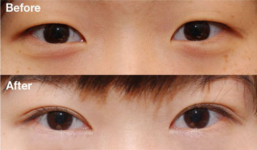 商丘微創(chuàng)雙眼皮手術(shù)多久能恢復(fù)？（圖）_1