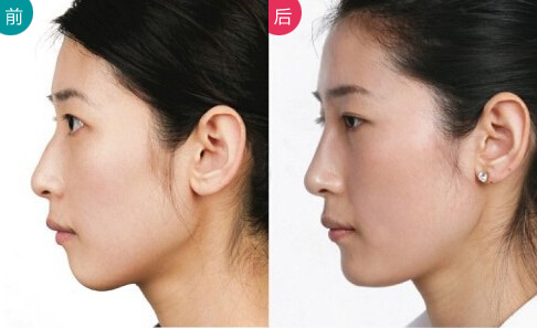 商丘玻尿酸注射下巴需要幾支呢?（圖）_1