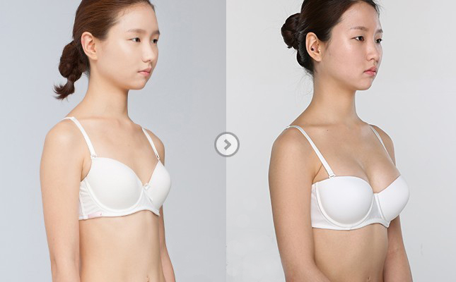 商丘隆胸假體取出要多少錢？（圖）_1