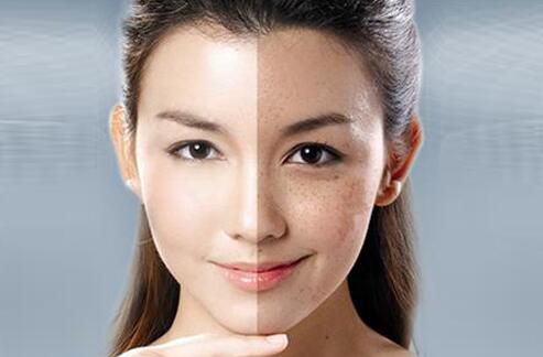 祛斑那種方法比較好，激光祛斑到底怎么樣（圖）_1