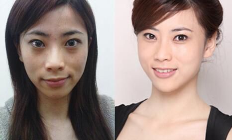 祛斑哪種方法好，祛斑大概要多少錢（圖）_1