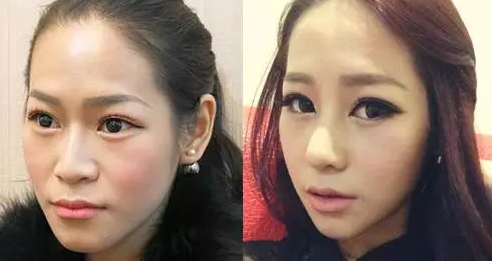 商丘哪家整容醫(yī)院假體隆鼻好?（圖）_1