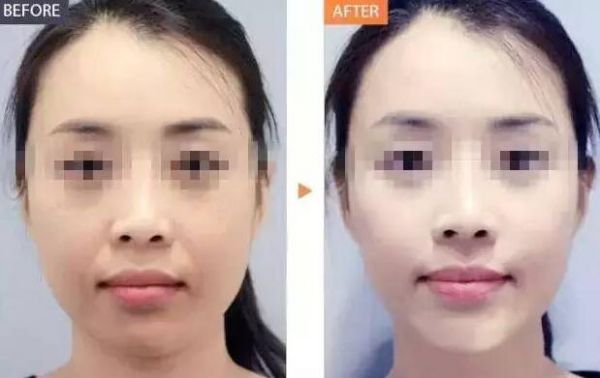 深圳最好的祛斑醫(yī)院  激光美容祛斑價(jià)格（圖）_1