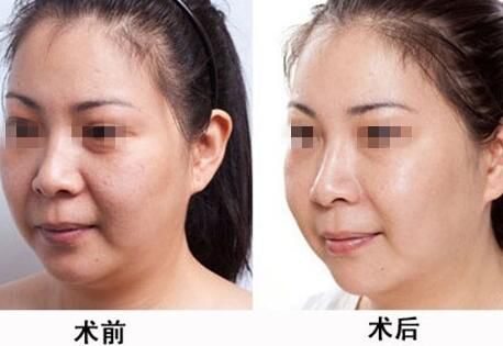 深圳哪里有激光祛胎記，祛胎記效果怎么樣（圖）_1