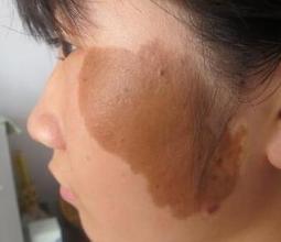 去胎記什么方法比較好，大概要多少錢（圖）_1