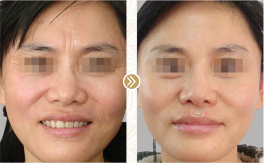 商丘哪里打除皺針好呢?（圖）_1