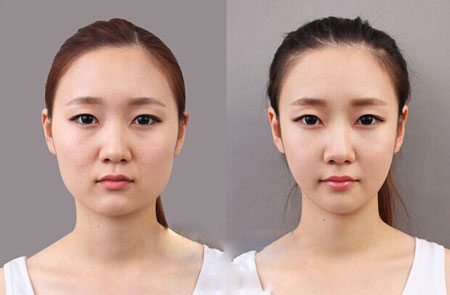 商丘面部吸脂手術(shù)會(huì)留下疤痕嗎？（圖）_1