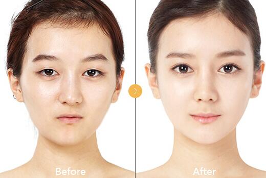 商丘自體脂肪豐太陽(yáng)穴哪家醫(yī)院好?（圖）_1