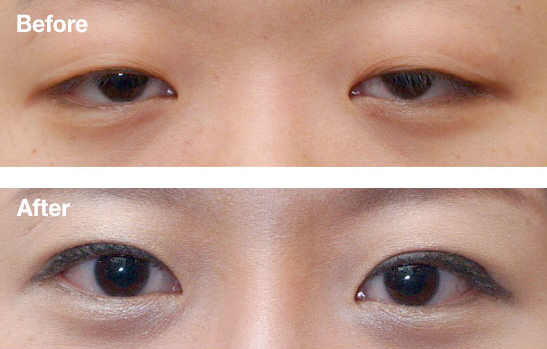 商丘哪個(gè)做上瞼下垂手術(shù)比較好？（圖）_1