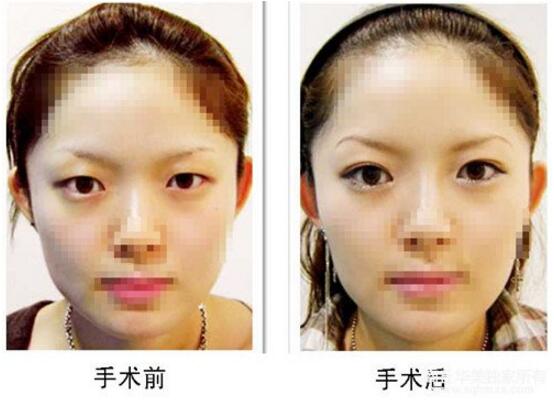 商丘全切雙眼皮和開內(nèi)眼角手術(shù)（圖）_1