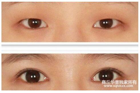 商丘開眼角要恢復多久？（圖）_1