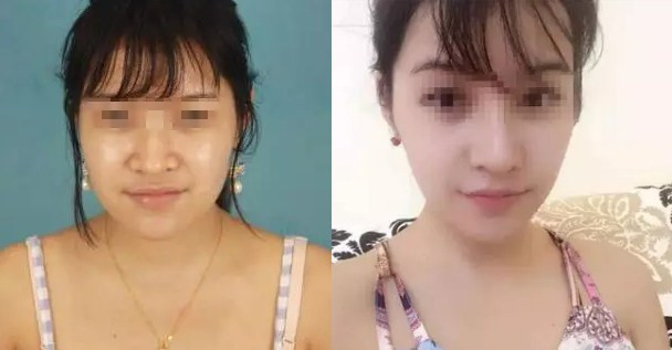 在商丘鼻翼修復費用高不高呢?（圖）_1