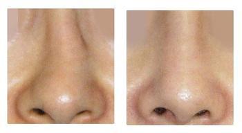 商丘歪鼻子怎么辦?（圖）_1