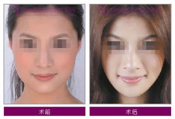 隆下巴有推薦的商丘比較好的整形醫(yī)院？（圖）_1