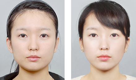 商丘正品瘦臉針價(jià)格（圖）_1