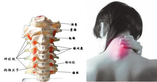 專(zhuān)家總結(jié)頸椎病不同發(fā)病期的癥狀，危害程度（圖）_1