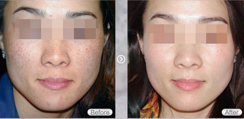 商丘華美整形美容醫(yī)院去雀斑手術(shù)怎么樣？（圖）_1