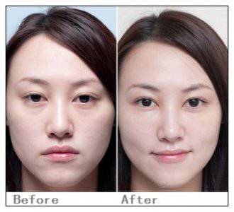 商丘打針劑除皺靠譜嗎？（圖）_1