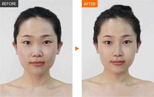 商丘華美假體隆鼻手術(shù)優(yōu)惠（圖）_1