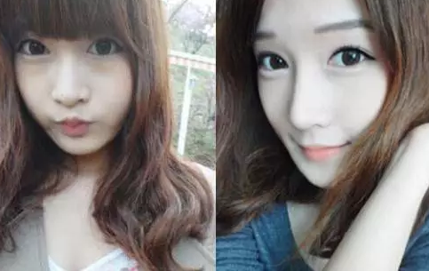 商丘做假體隆鼻后看上去會不會顯假呢?（圖）_1