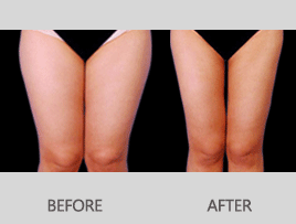 商丘大腿吸脂后會(huì)反彈嗎（圖）_1