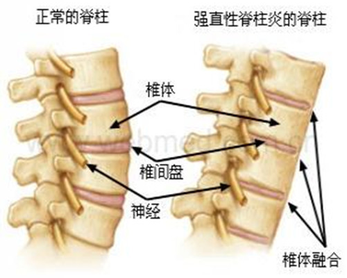 頸椎病類型有哪些？怎么改善好？（圖）_2