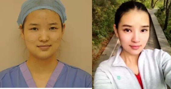 商丘韓式微創(chuàng)雙眼皮手術(shù)（圖）_1