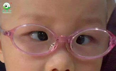 眼科專家提醒：“斗雞眼”不一定就是斜視！（圖）_1