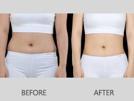 商丘腰腹部吸脂手術(shù)多少錢？（圖）_1