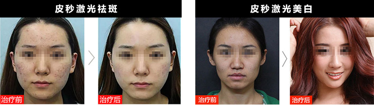 美容院激光祛斑儀器多少錢一臺（圖）_4