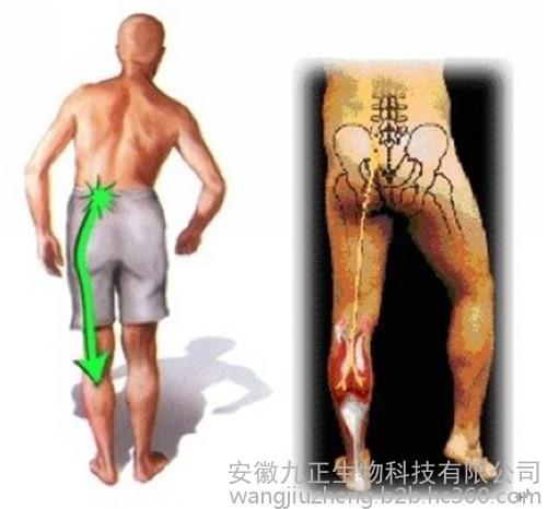 腰間盤突出引起的嚴(yán)重后果你了解多少_1