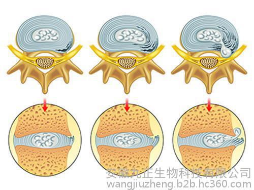 腰間盤突出引起的嚴(yán)重后果你了解多少_2
