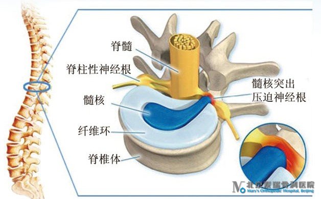 腰椎间盘突出类骨科疾病的临床表现（图）_1