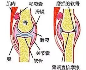 滑膜炎怎么改善才是可以根治呢？_1