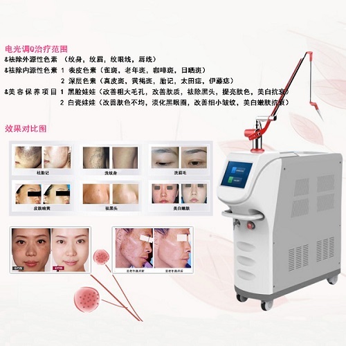 祛斑儀器哪種好（圖）_3