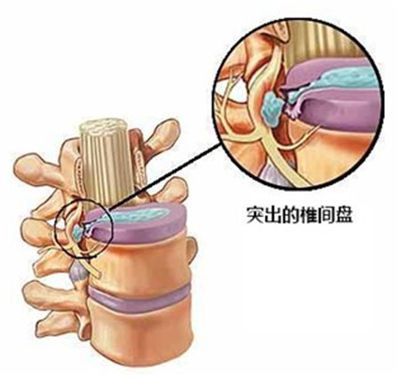 腰椎間盤突出除了手術最佳的改善方法是什么？_2